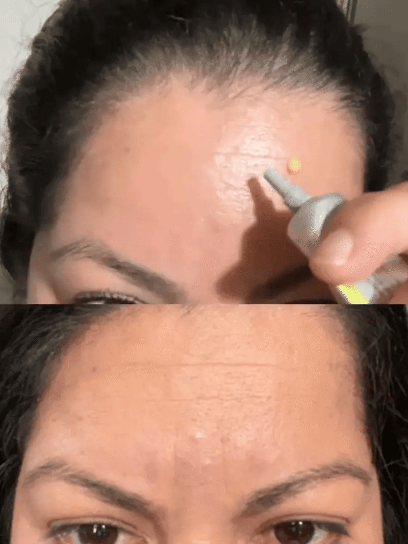 Renovea Retinal Shot | Suaviza Arrugas y Reafirma La Piel